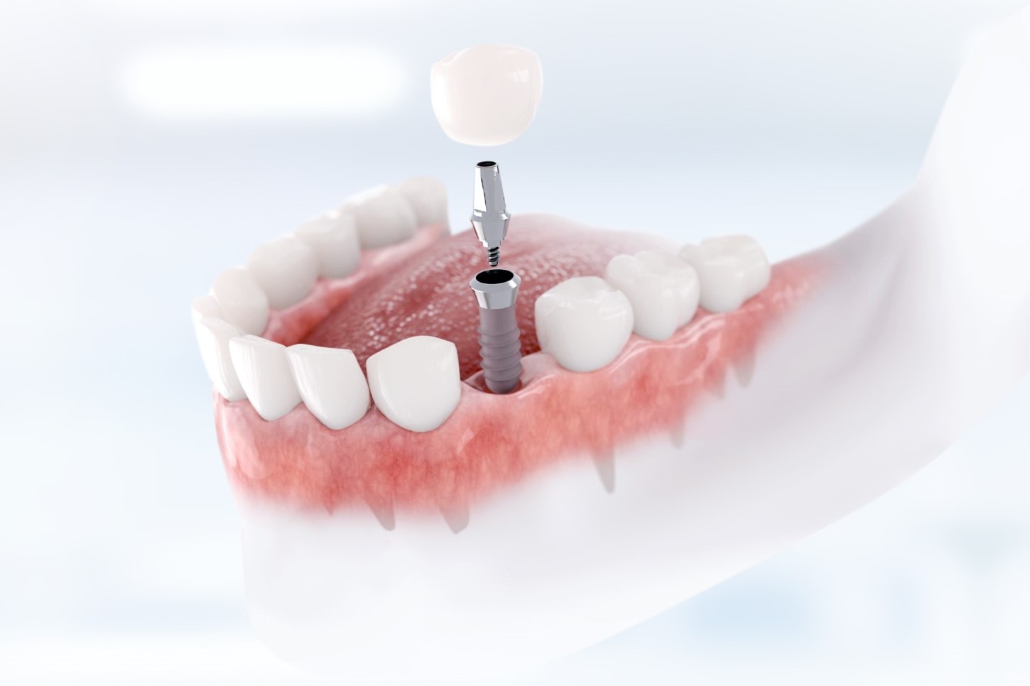 Имплантация с системой OSSTEM